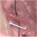 photo of surgery to develop a renal artery stenosis model
