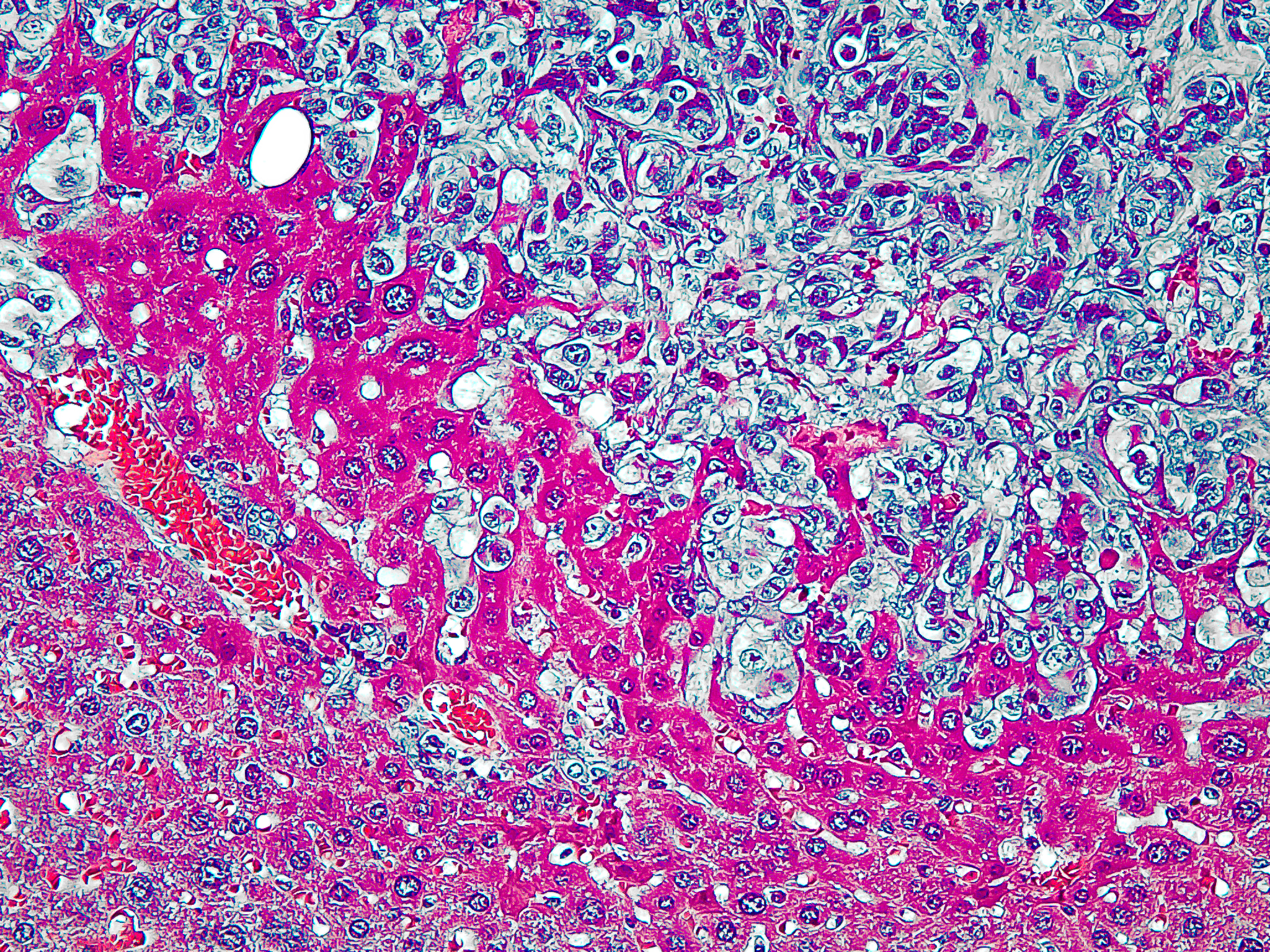 Liver Metastasis in Kaposi Sarcoma Mouse Model