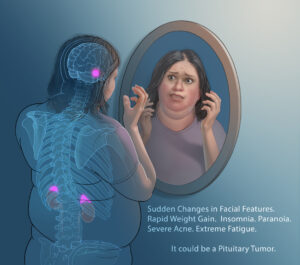Pituitary Tumor Symptoms - UNC Health Department of Neurosurgery