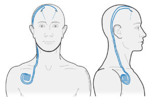 Deep brain stimulation (DBS) placement figure 1