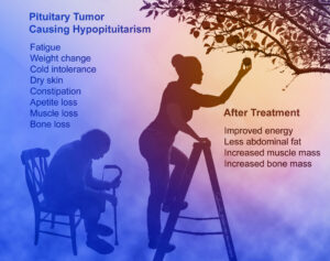 Pituitary tumor symptoms and results from after treatment