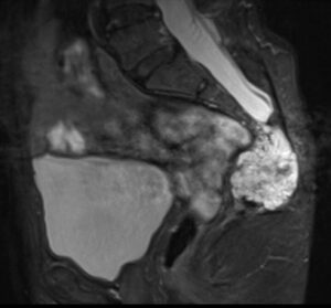 MRI image showing tumor before surgery