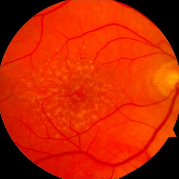 Photograph of a macula (the highly sensitive center of the retina) with intermediate age-related macular degeneration.
