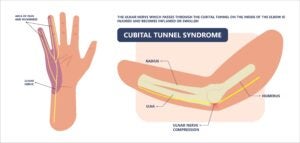 Image describing the areas of the body affected by Cubital Tunnel Syndrome.