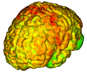 Cortical Thickness