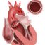 TAVR, in which a device is inserted to open the aortic valve, was approved by the FDA in late 2011.