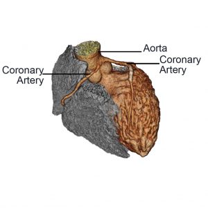 Anomalous Aortic Origin of the Coronary Artery (AAOCA)