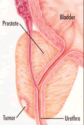 Prostate 3