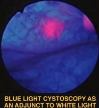 Blue Light Cystoscopy