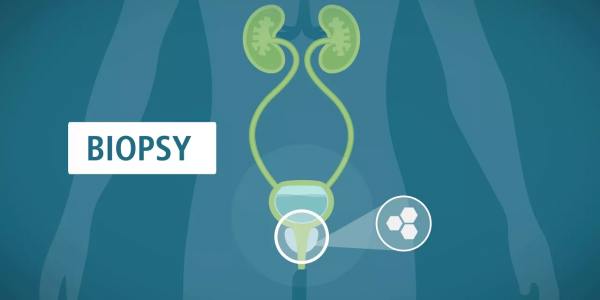 Prostate Biopsy: What You Should Know