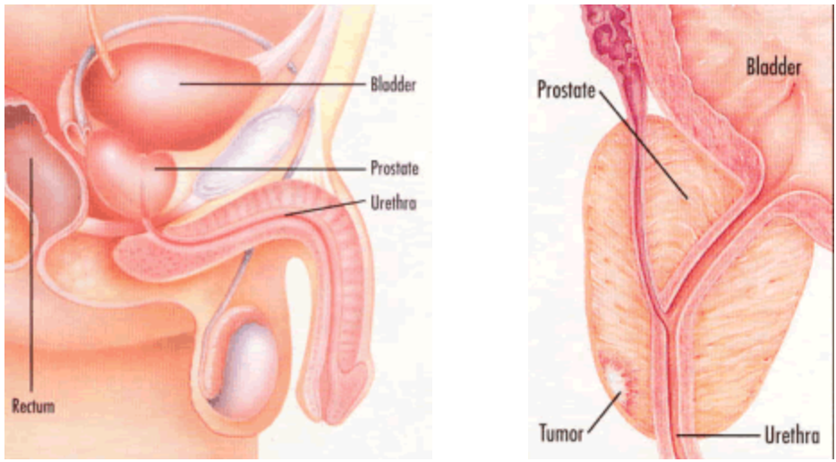 symptoms of aggressive prostate cancer