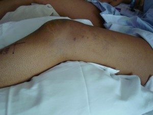 Venous Malformation of the Leg