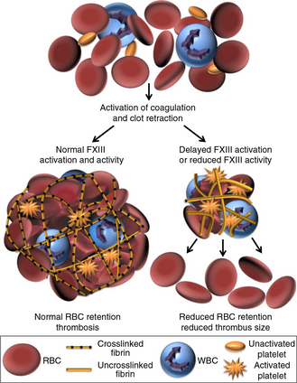 Factor XIII(a) mediates red blood cell (RBC) retention in thrombi. During venous thrombosis (VT), platelets mediate thrombus contraction. FXIII activity increases RBC retention in retracted thrombi (left arrow). If FXIII activity is deficient or activation is delayed, fewer RBCs are retained, resulting in a smaller thrombus (right arrow).